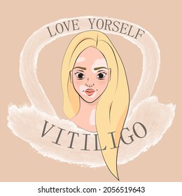 White blonde woman with vitiligo. World vitiligo day. Body positive and selflove.