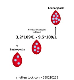 White blood cell count. Leukopenia. Leukocytosis. Infographics. Vector illustration.