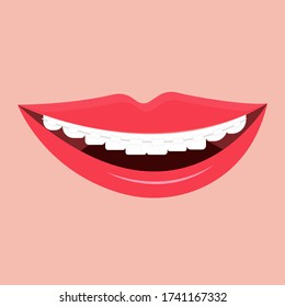 White Clear Teeth With Ceramic Braces, smiling, happy, fashion stock vector illustration. Stomatology, orthodontic, dental concept. Corrective equipment, healthcare.