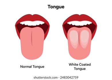 White coated tongue and normal tongue 