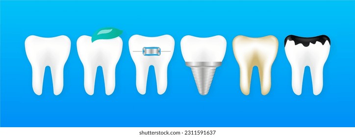 White and decayed teeth, dental implant. Different tooth conditions. Dental model of teeth in the gum. Dental care concept. Vector Illustration.