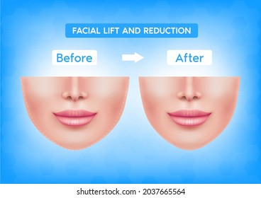 White female face before after plastic surgery jaw reduction and botox injections facial lift and reduction. For advertising of plastic surgery. Medical and beauty concept. Vector EPS10 illustration.