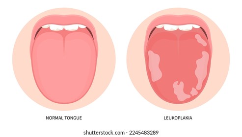 White fungal inflamed in mouth cancer ulcer swelling oral pain angular canker sore viral pink trauma burnt throat tonsils gums dry of hunter median celiac iron virus B12 anemia immune system red fever