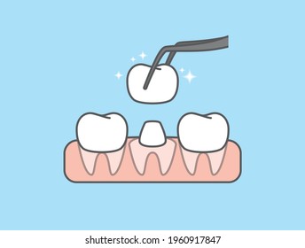 The white real root tooth is restored by the crown tooth. illustration vector design on blue background. Dental care concept.