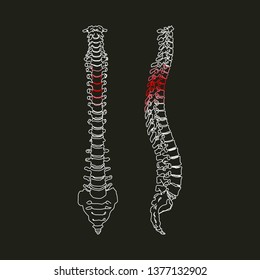 White Silhouette Of Human Spine With Focus Of Pain In The Thoracic Area On Black Background Vector Illustration