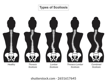 Coluna branca em um corpo negro. A escoliose é uma curva lado a lado da coluna vertebral que muitas vezes se assemelha a uma forma "C" ou "S" quando vista de trás. Assistência médica, ilustração Vetor.