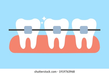 Dientes blancos con cepas dentales ilustraciones planas vectoriales. Alineación del mordisco de los dientes. Servicio de clínica dental, odontología cosmética, enderezamiento de dientes y concepto de procedimientos ortodoncicos.