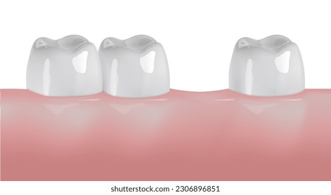 Los dientes blancos se hilan en goma. Implantes cerámicos naturales o artificiales sanos, coronas o puentes dentales. Antecedentes estomatológicos o clínicos dentistas