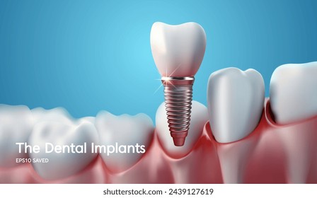 White tooth implant implant cut, healthy tooth or dental surgery.