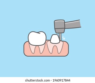 The white tooth is trimmed by handpiece dental instrument to prepare for the crown tooth. illustration vector design on blue background. Dental care concept.