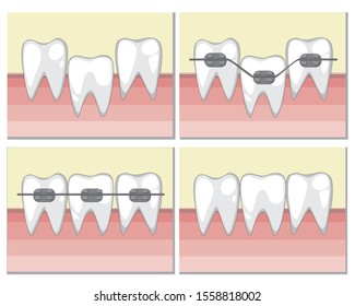 White vector teeth with metal braces and pink healthy gum. A vector stock illustration for dentists and orthodontists with oral cavity. The concept of bite correction in adults and children