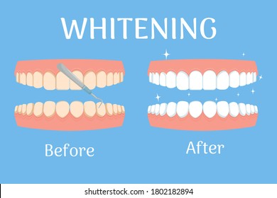 Whitening teeths before and after, stomatology, dental concept isolated. Healthcare and beauty stock