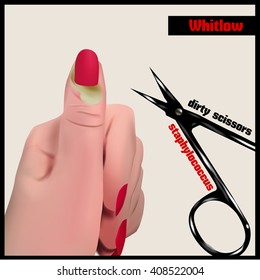 Whitlow. An abscess in the soft tissue near a fingernail.