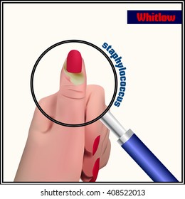 Whitlow. An abscess in the soft tissue near a fingernail.