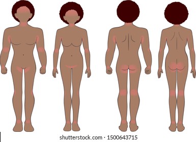 Whole body of the man and woman, suffers from a skin disease;  rash, heat rash.