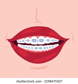 Wide female smile with braces with red lips. Clean teeth with mouthwash in flat design. Smiling teeth cartoon dental care. Oral healthcare with mouthwash for plaque prevention and fresh breath.