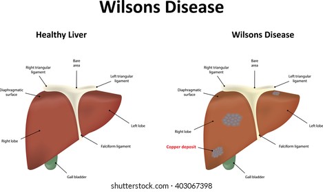 Wilsons Disease