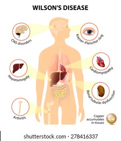 Wilsons disease or hepatolenticular degeneration. Signs and symptoms