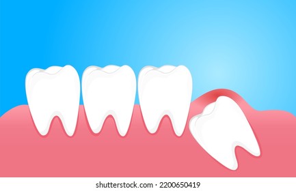 Wisdom Teeth Cause Pain To The Gums