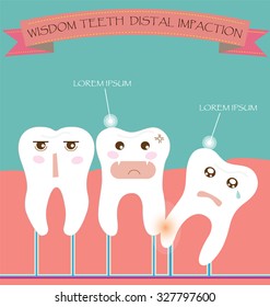 Wisdom Teeth Distal Impaction