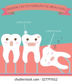 Wisdom Teeth Horizontal Impaction