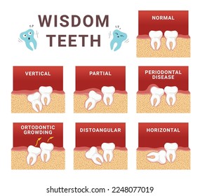 Wisdom teeth impaction scheme dentistry medical education set vector flat illustration. Dental eruption oral tooth disease normal vertical partial periodontal orthodontic distoangular horizontal