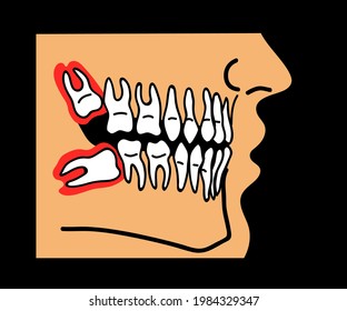 Wisdom teeth in the mouth. Cartoon. Vector illustration.