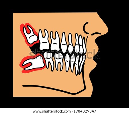 Wisdom teeth in the mouth. Cartoon. Vector illustration.