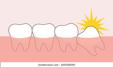 Wisdom teeth on pink background