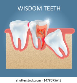 Plantilla de póster de dientes sabios, ilustración realista vectorial. Diente de la sabiduría que causa problemas dentales como la caries dental o caries a otros dientes. Concepto de salud dental.