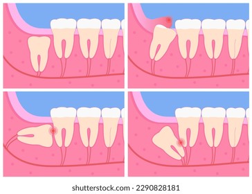 Wisdom teeth under the gum growth concept. Wisdom tooth impaction