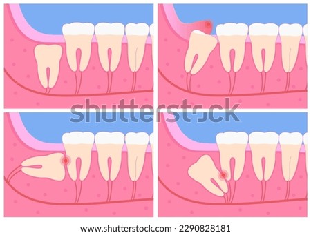 Wisdom teeth under the gum growth concept. Wisdom tooth impaction