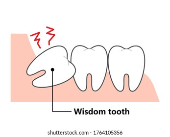  Wisdom tooth and alignment　orthodontic