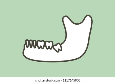 wisdom tooth ( angular or mesial impaction ) in mandible or lower jaw - dental cartoon vector flat style cute character for design