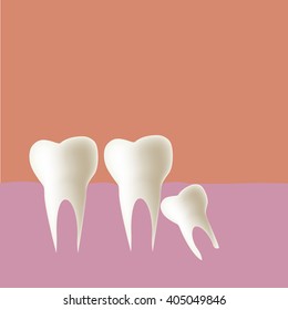 Wisdom tooth (Angular) in mouth, Vector illustration.