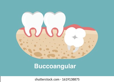 Wisdom tooth ( Buccoangular impaction ) illustration Vector.