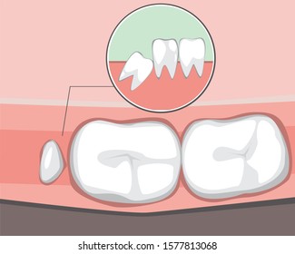 Wisdom tooth, dental problem. Flat vector stock illustration. Wisdom teeth growth concept, orthodontic problem. Illustration with molar, gum. Wisdom tooth in the mouth