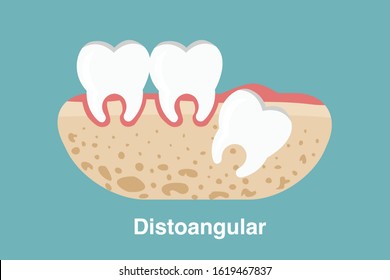 Wisdom tooth ( distoangular impaction ) illustration Vector.