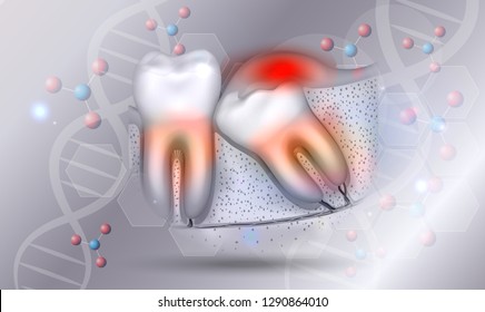 Wisdom tooth eruption inflamed gums illustrated anatomy on a beautiful abstract scientific background