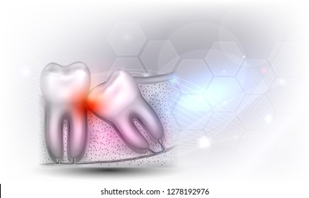 Wisdom tooth eruption problems illustrated anatomy on a beautiful light grey glowing background