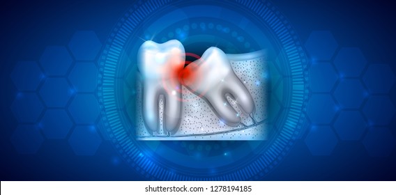 Wisdom tooth eruption problems illustrated anatomy on an abstract blue background