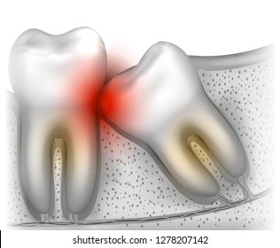 Wisdom tooth eruption problems illustrated anatomy