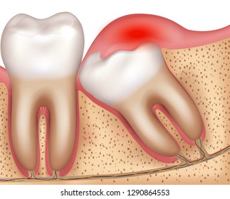 Wisdom tooth eruption problems inflamed gums illustrated anatomy