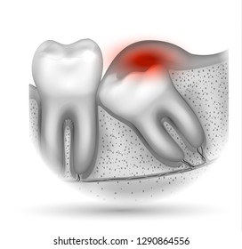 Wisdom tooth eruption problems inflamed gums illustrated anatomy