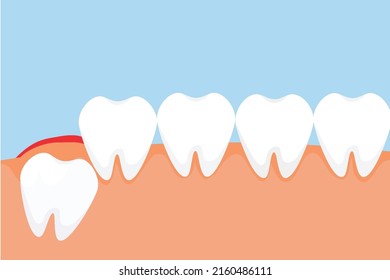 A wisdom tooth erupts through the gum and gives a red pain signal concept. Dangerous wisdom toothache causes gum pain vector. Tooth pushing from the inside and giving pain to the gum.