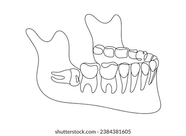 The wisdom tooth is growing incorrectly. Impacted tooth. One line drawing for different uses. Vector illustration.