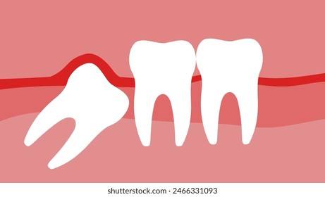 A wisdom tooth grows, flat color illustration