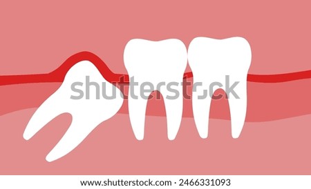 A wisdom tooth grows, flat color illustration