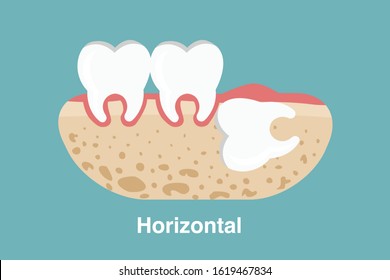 Wisdom tooth ( Horizontal impaction ) illustration Vector.
