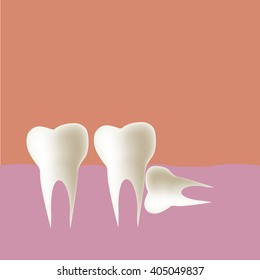 Wisdom tooth (Horizontal) in mouth, Vector illustration.